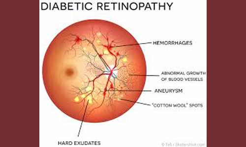 ഡയബറ്റിക് റെറ്റിനോപ്പതി