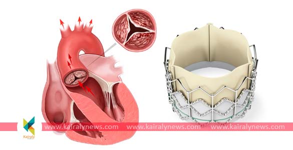 കേരളത്തില്‍ ആദ്യമായി തദ്ദേശ നിര്‍മിത ടാവി വാല്‍വ് വിജയകരമായി ഘടിപ്പിച്ച് ആസ്റ്റര്‍ മെഡിസിറ്റി