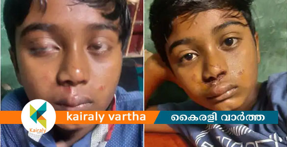 കുതിരയുടെ ആക്രമണത്തില്‍ ബാലന് പരിക്കേറ്റു; പുറത്ത് പറയാതിരിക്കാൻ ഉടമയുടെ ഭീഷണി