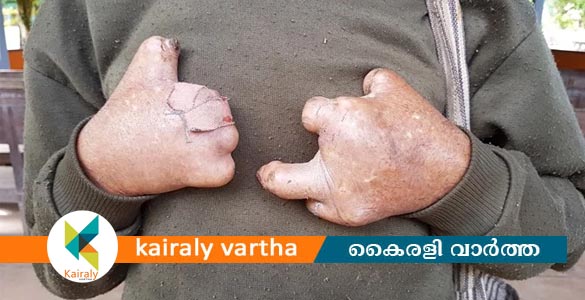 അശ്വമേധം 7.0 കുഷ്ഠരോഗ നിർണയ ഭവനസന്ദർശനം ജനുവരി 7 മുതൽ