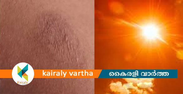 വളയത്ത് അങ്കണവാടി ടീച്ചർക്ക് സൂര്യാതാപമേറ്റു